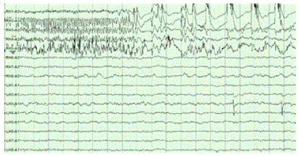 Epilepsy-_right_hippocampal_seizure_onset
