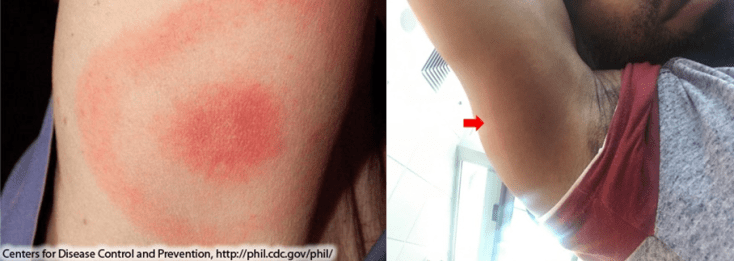 erythema_migrans