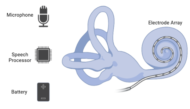 How cochlear implants create sound for the hard of hearing – PennNeuroKnow